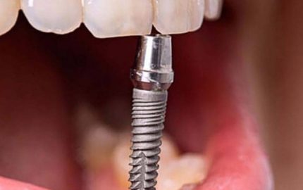 implant tedavisi hangi aşamalardan oluşur