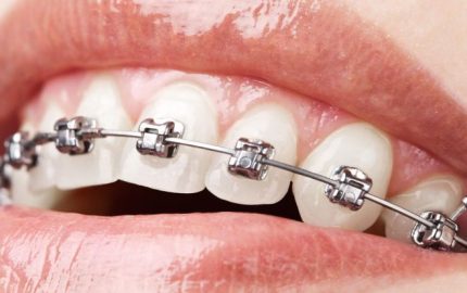 Ortodontik tedavi